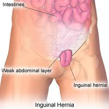 Houston Offshore Hernia Injury Lawyer