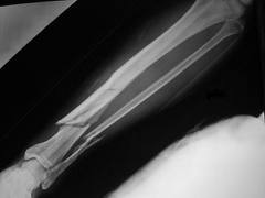 Houston offshore lawyer broken bones