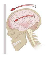 Concussions Attorney